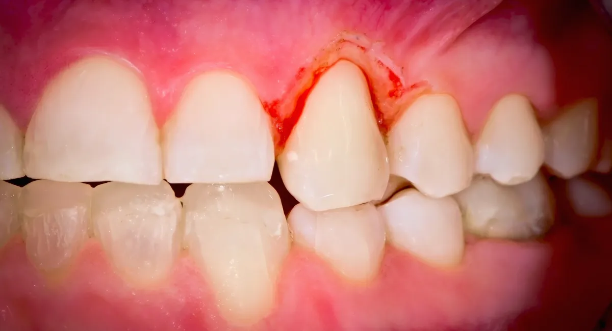 عکس زوم شده از دندان‌ها و یک دندان با لثه خونی